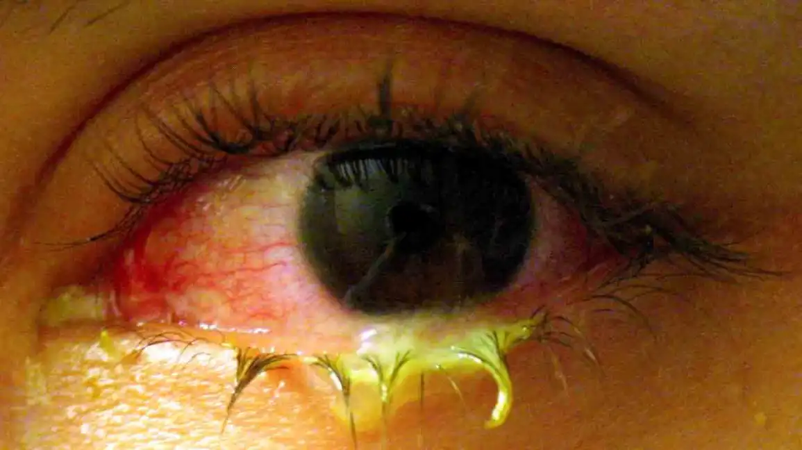 आँखा पक्ने संक्रमण, चार दिन विद्यालय बन्द