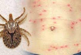 बाजुरामा ‘स्क्रब टाइफस’का बिरामी बढ्दै