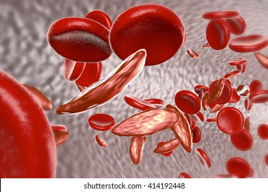 सिकलसेलका बिरामीको निशुल्क बीमा हुँदै